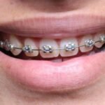 diamond braces