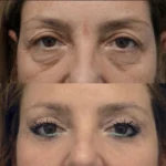 Eye Bag Removal